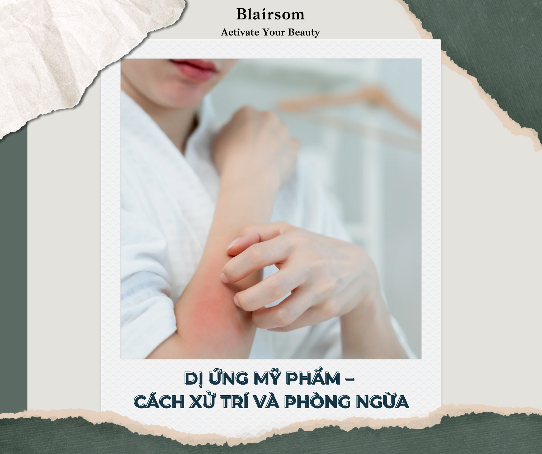 DỊ ỨNG MỸ PHẨM - CÁCH SỬ TRÍ VÀ PHÒNG NGỪA