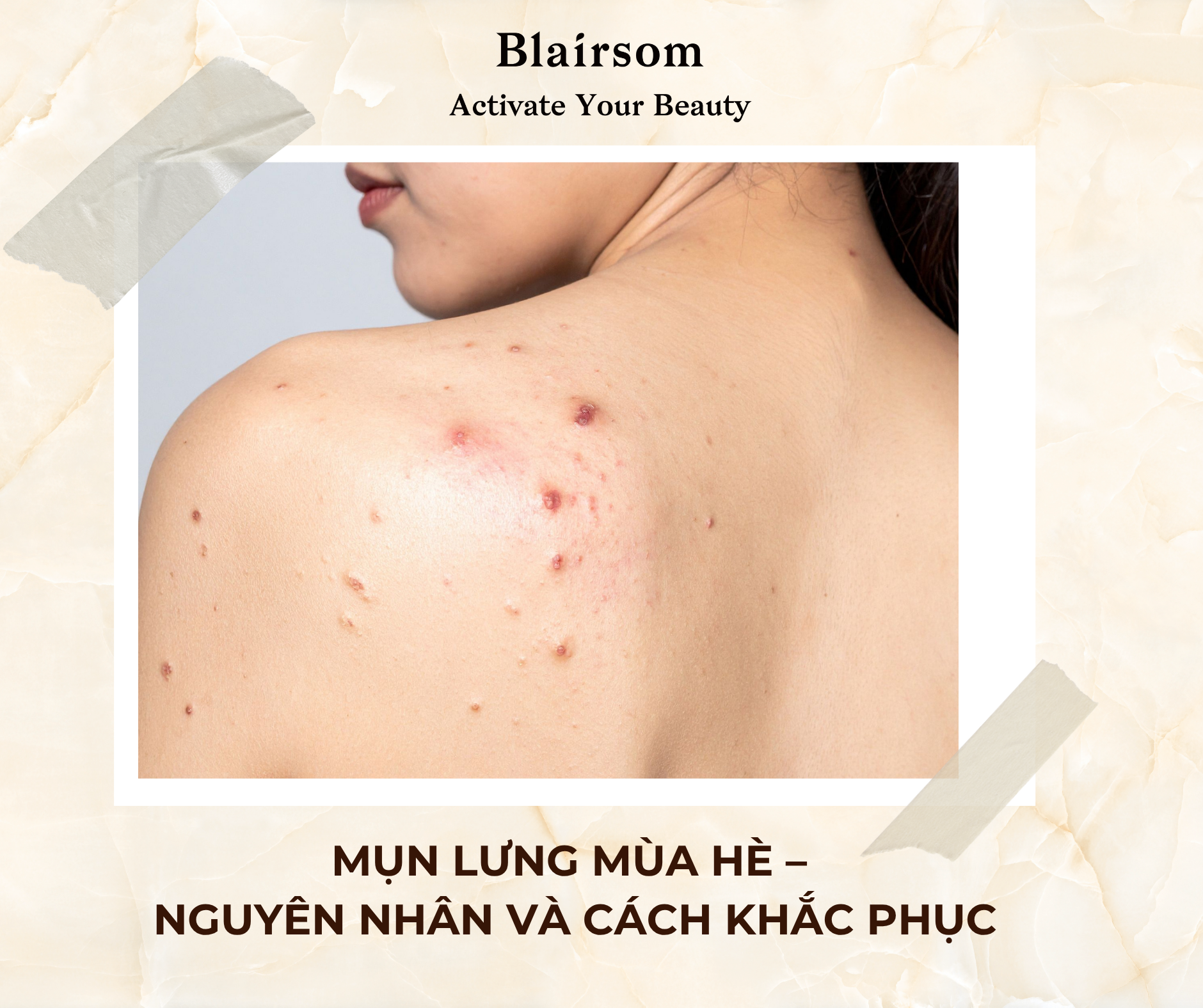 🔗  MỤN LƯNG MÙA HÈ - NGUYÊN NHÂN VÀ CÁCH KHẮC PHỤC