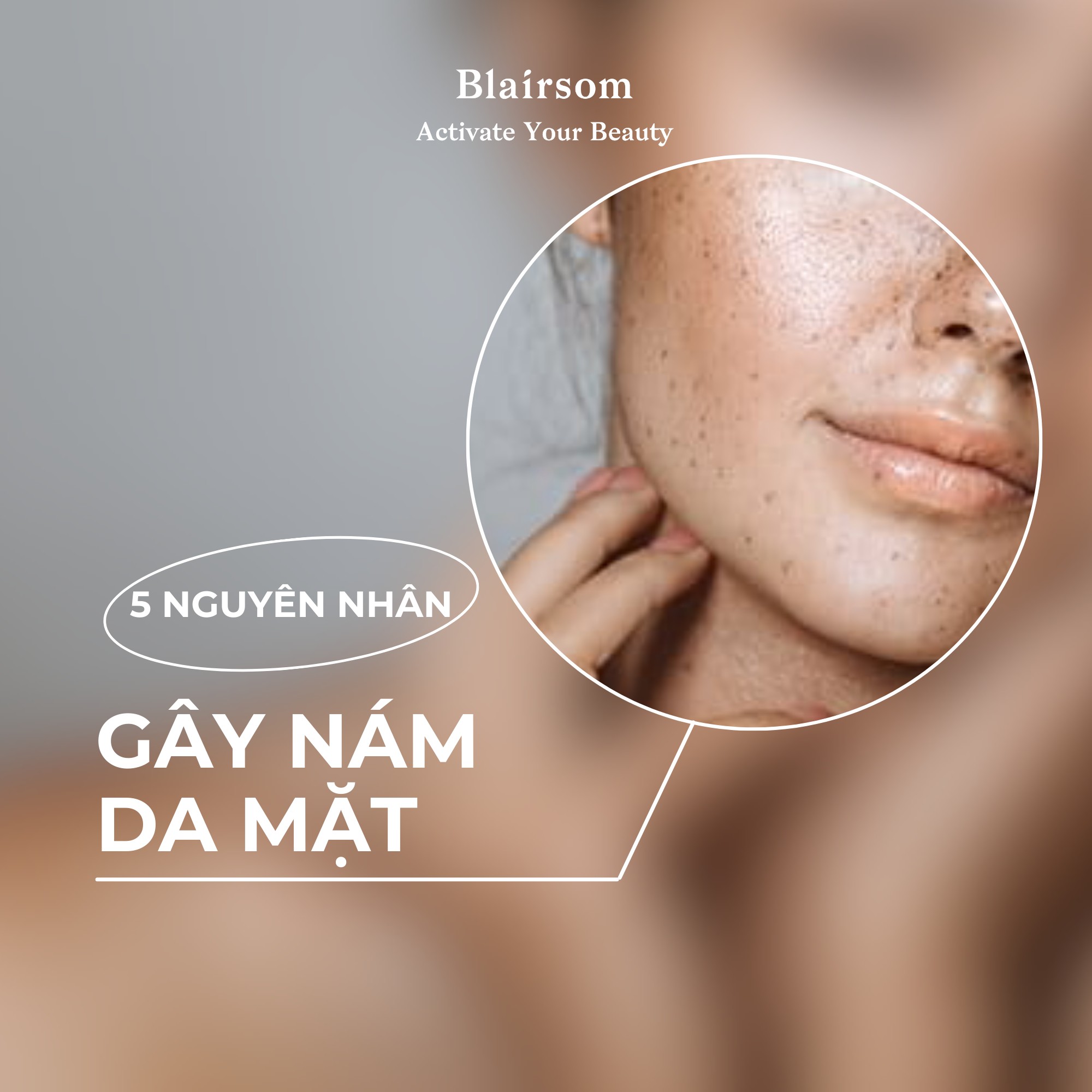 5 NGUYÊN NHÂN GÂY NÁM DA MẶT
