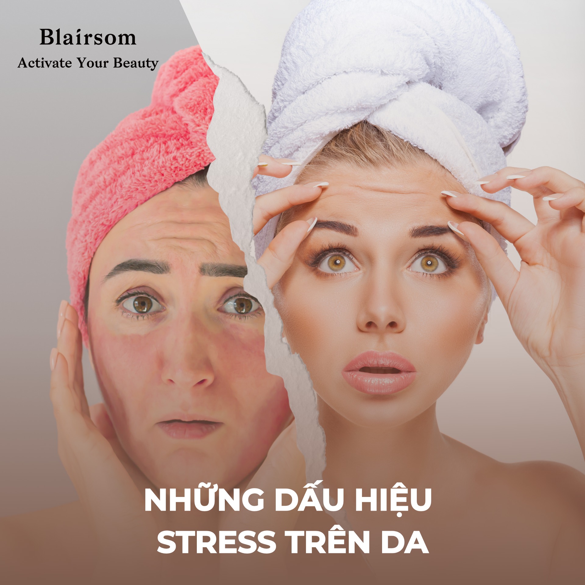 NHỮNG DẤU HIỆU STRESS TRÊN DA