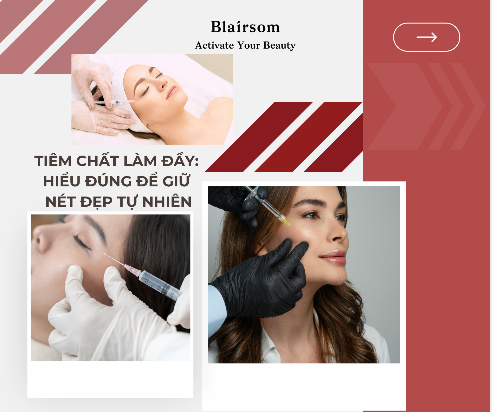 🔎TIÊM CHẤT LÀM ĐẦY: HIỂU ĐÚNG ĐỂ GIỮ NÉT ĐẸP TỰ NHIÊN